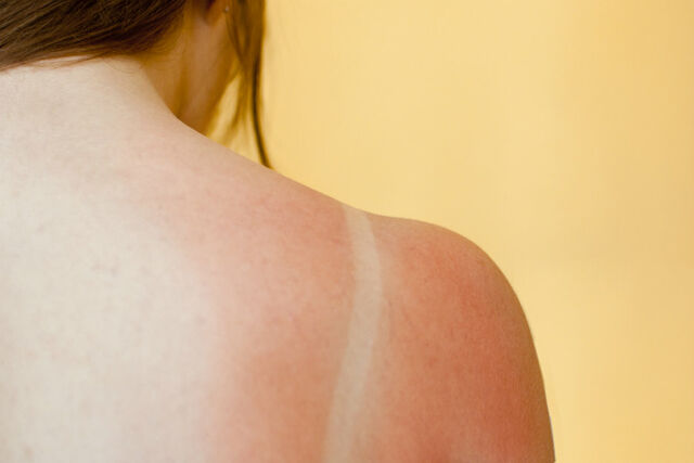 Verbrand? Gebruik liever geen aftersun