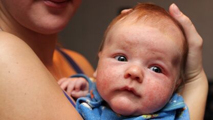 Wat voor soort eczeem heeft mijn baby?