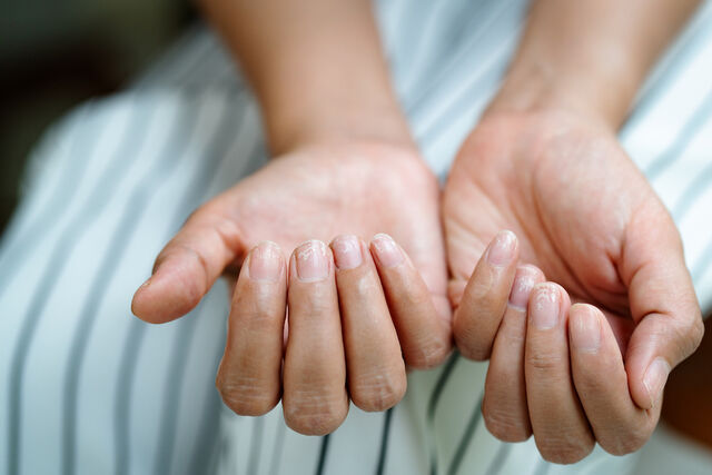 witte stipjes nagels